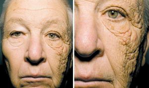 Face of truck driver showing damage done to face by years of sun ultraviolet radiation