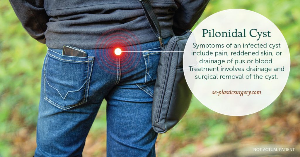 Pilonidal cyst illustration over image