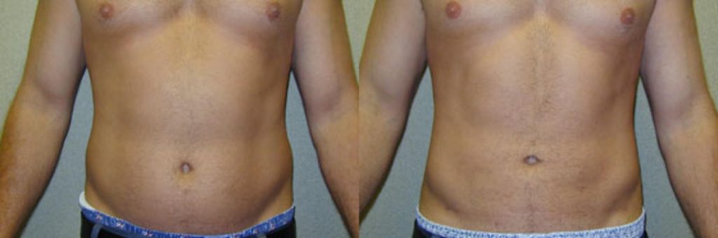 Liposuction Before and After