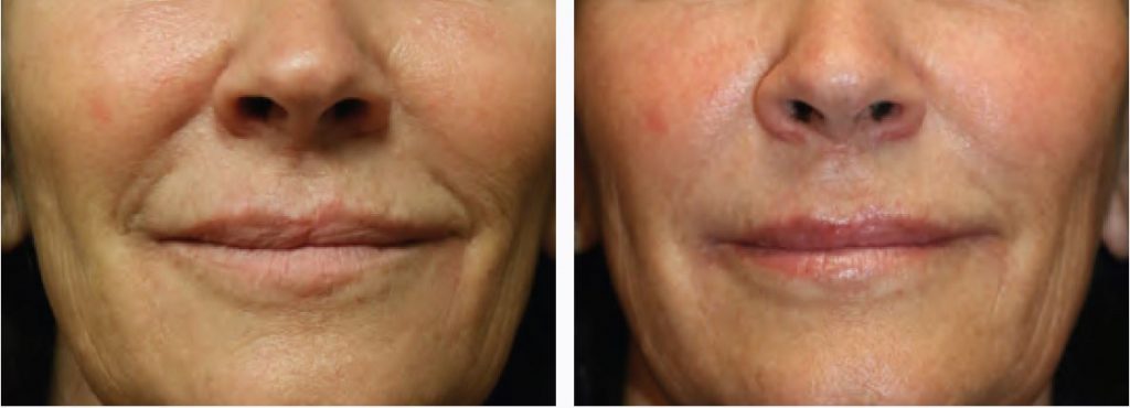 Potenza RF microneedling of the face - results shown after 1 treatment