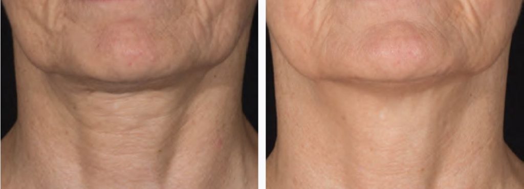Potenza RF microneedling of the neck - results shown after 1 treatment