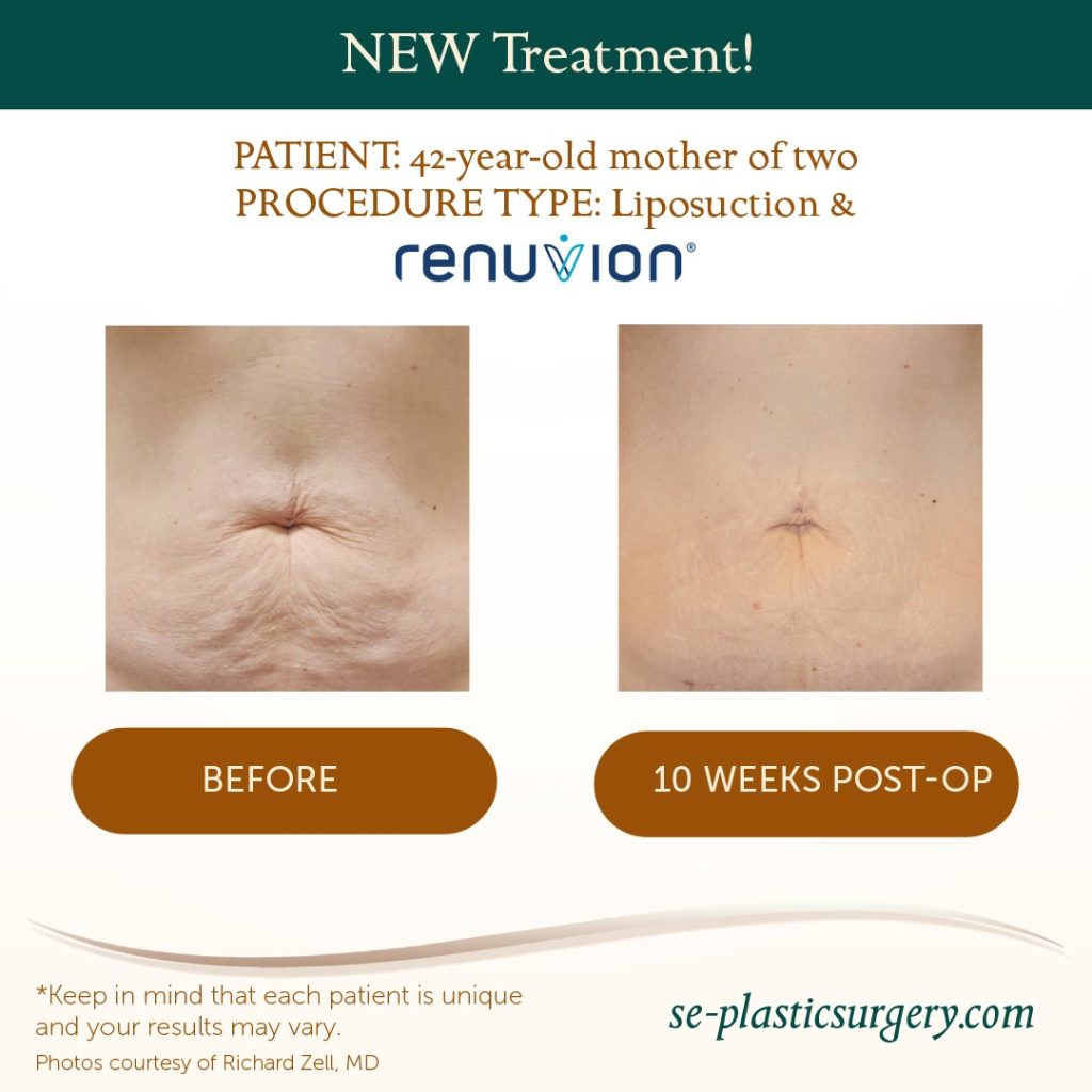 Renuvion non-invasive skin tightening before and after - abdomen