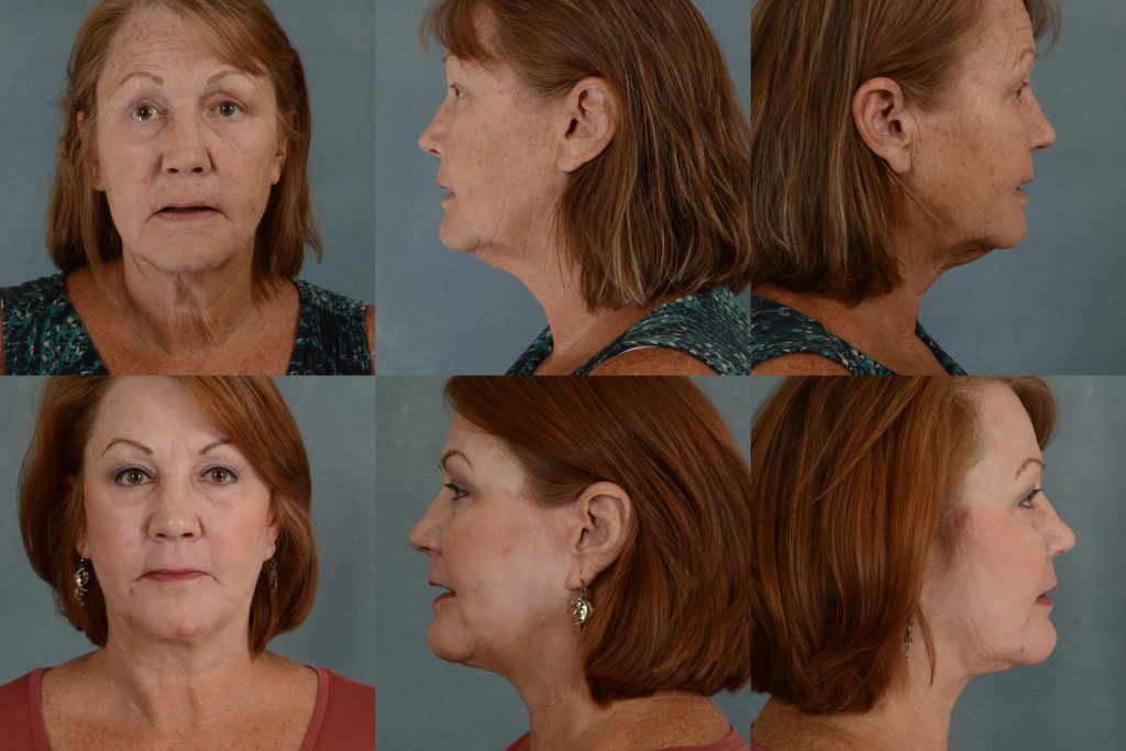 Real patient image before and after a facelift with eyelid lift.