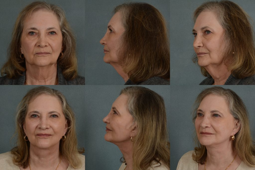 Real patient image before and after a facelift with a neck lift.