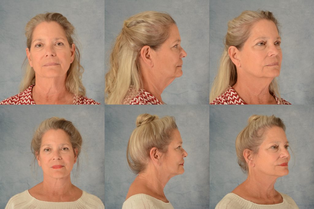 Real patient image before and after a facelift.