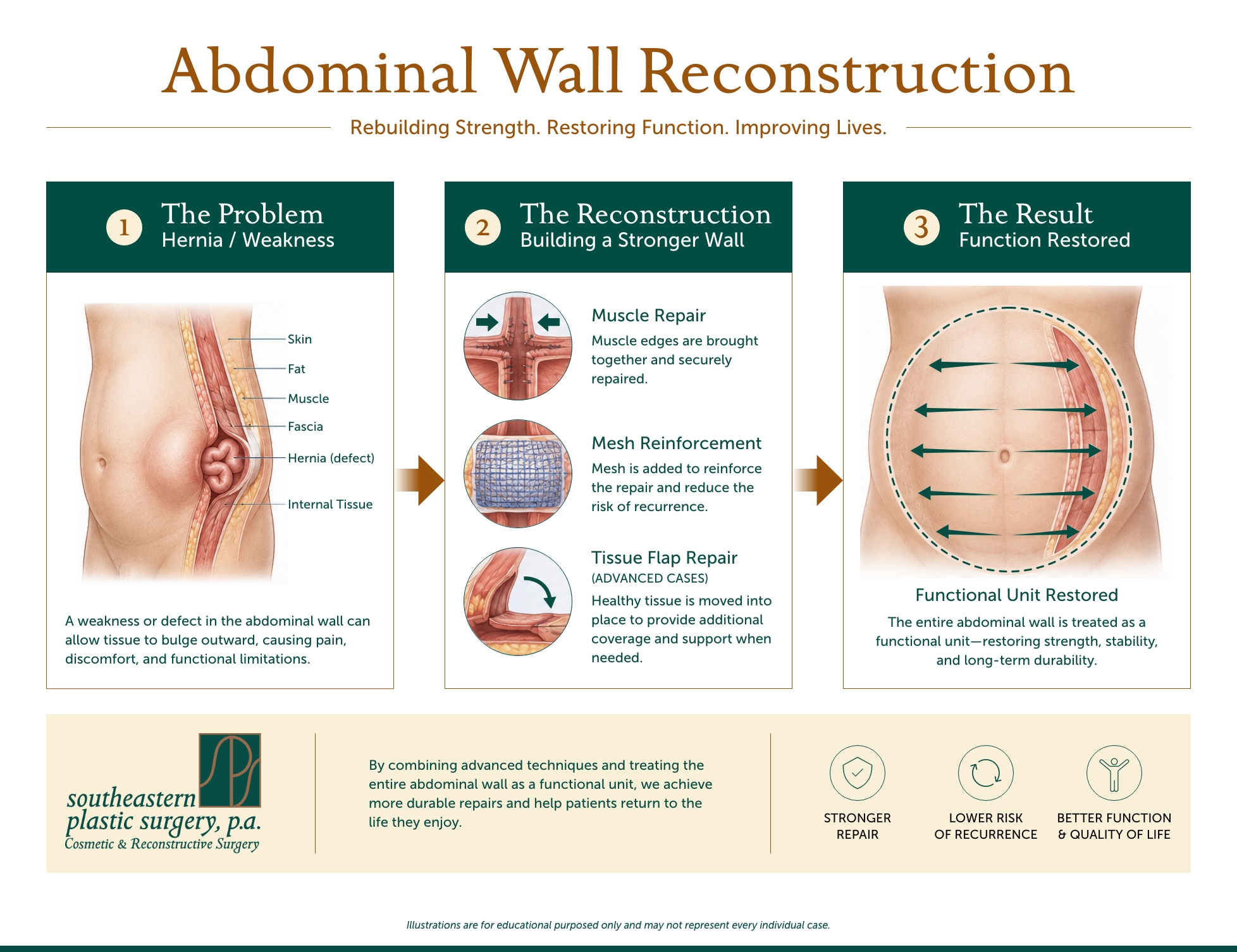 Infographic explaining abdominal wall reconstruction surgery, including hernia repair, muscle repair, mesh reinforcement, and restoration of abdominal function.