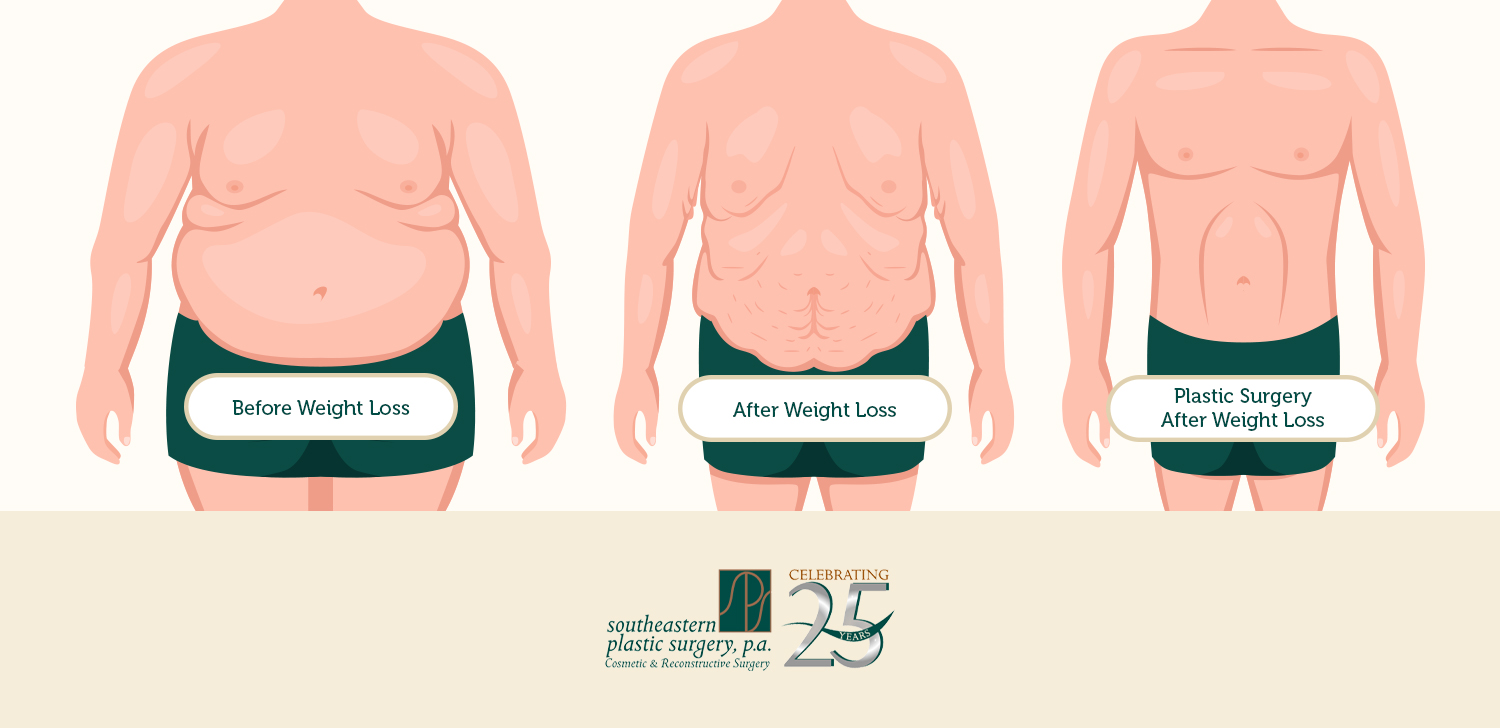Infographic comparing a man’s body before weight loss, after significant weight loss with excess skin, and after body-contouring plastic surgery.